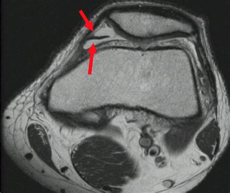 Plica Knee Condition | David Slattery