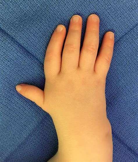 Thumb Deformity | Congenital Hand and Arm Differences | Washington University in St. Louis