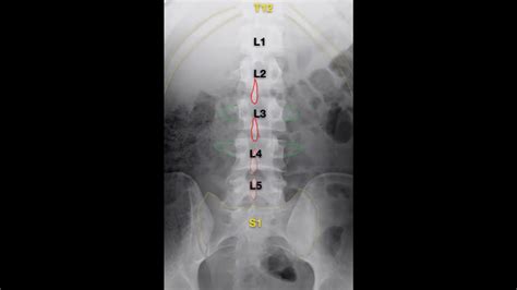 Lumbar Spine X Ray Anatomy And Interpretation Checklist Grepmed | The Best Porn Website