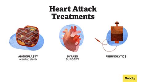 Heart Attack Treatment Diagram