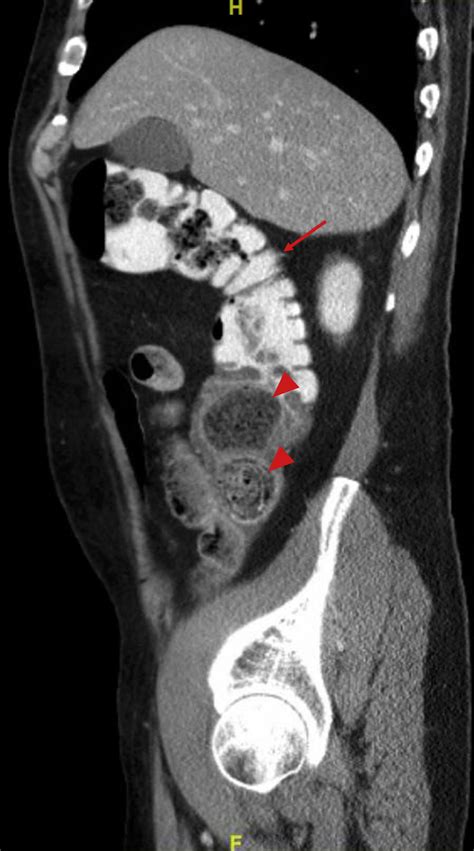 Sagittal reformats of an abdominal CT scan performed with IV, oral, and... | Download Scientific ...