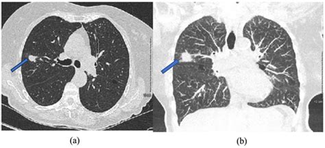 Lady Windermere Syndrome: An Interesting Clinical and Radiological ...