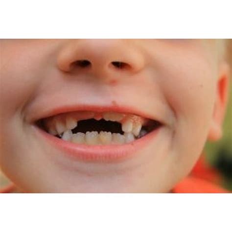 Shark Teeth in Children | Healthfully