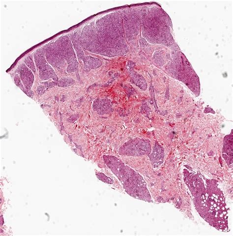 Pathology Outlines - Leprosy