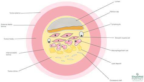 10. Atherosclerosis - SimpleMed - Learning Medicine, Simplified