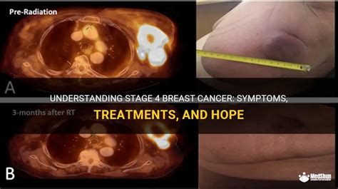 Understanding Stage 4 Breast Cancer: Symptoms, Treatments, And Hope | MedShun