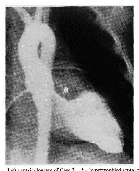 Figure 1 from Surgical treatment of idiopathic hypertrophic subaortic ...