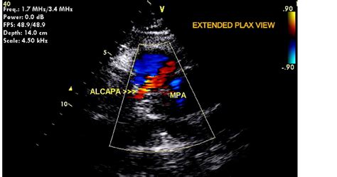 Anomalous Origin of Left Coronary Artery from Main Pulmonary Artery ...