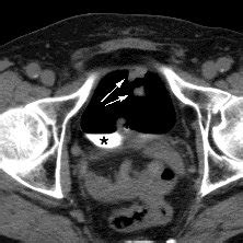 73 year old male with history of bladder cancer and hematuria. | Download Scientific Diagram