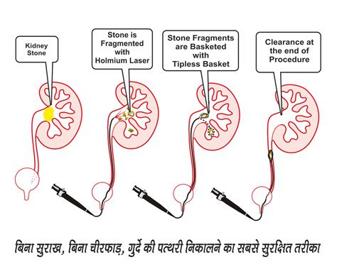 kidney-stone-treatment