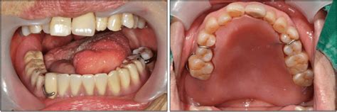 A palatal augmentation prosthesis was made to improve the pronunciation ...