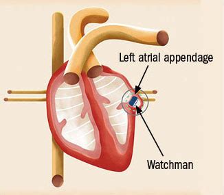 A device to prevent strokes in afib - Harvard Health