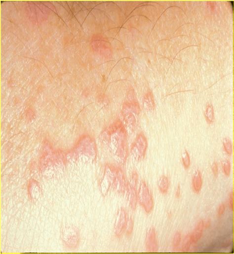 Lichen Planus - Symptoms, Types and Treatment | medcaretips.com