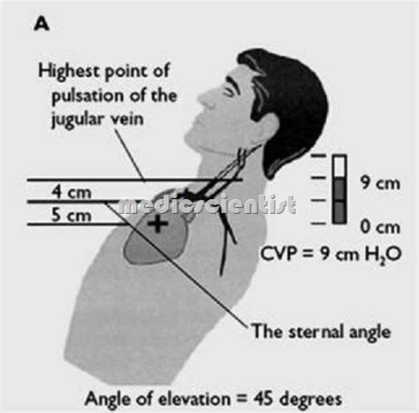 Examination of arterial pressure pulse with Jugular Venous Pulse (JVP) - || MedicScientist ...