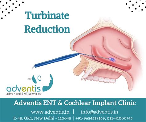 Turbinate Reduction, Nasal Turbinate Reduction Treatment & Surgery | Adventis