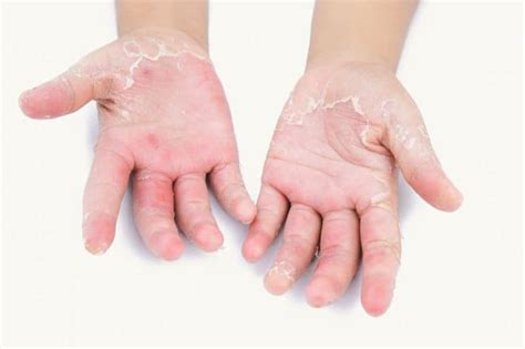 Treating Palmar/Plantar Psoriasis | The Dermatology Center Of Indiana