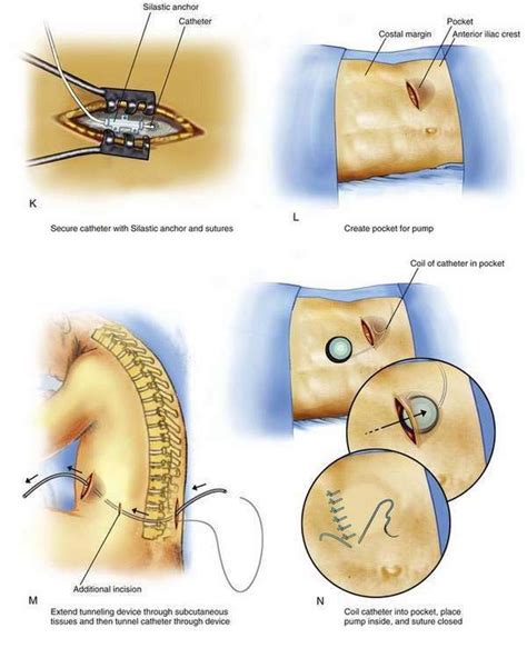 Intrathecal Catheter Implantation | Clinical Gate