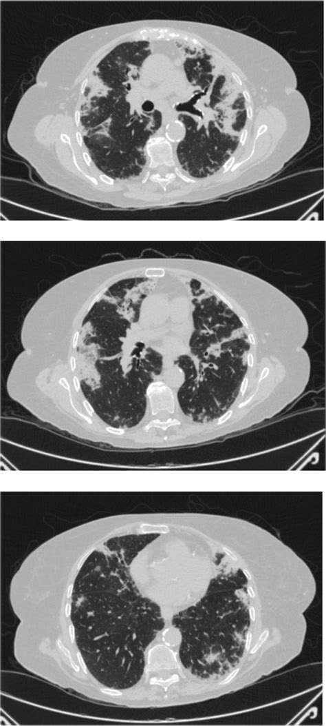 a. b -3c showing bilateral upper and lower lobe consolidations. Shin et ...