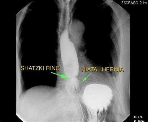 Schatzki Ring Vs Achalasia Diet - dotposts