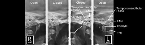 Temporomandibular Joints (TMJ) Radiographic Anatomy - wikiRadiography | Tmj, Tmj relief ...