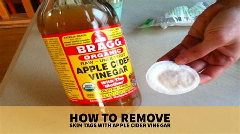 How to Remove Skin Tags with Apple Cider Vinegar? – Wellness.guide