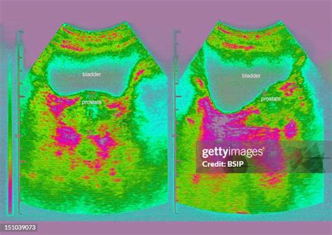 49 Bladder Ultrasound Stock Photos, High-Res Pictures, and Images ...