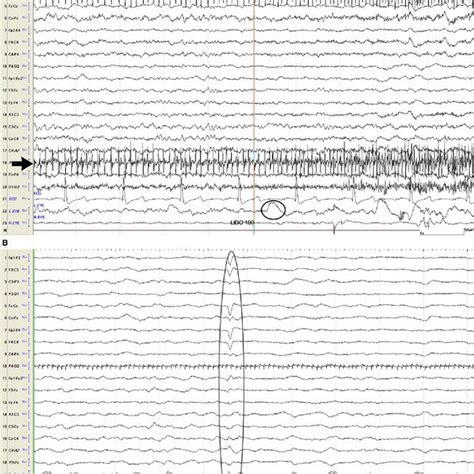 A) This EEG recording is depicting the end of the intrathecal infusion... | Download Scientific ...