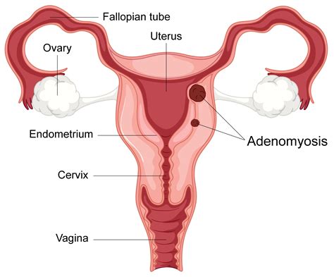 Posterior Wall Uterus