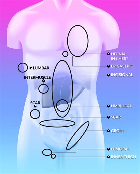 An unusual bulge in the groin could be a hernia | The Star