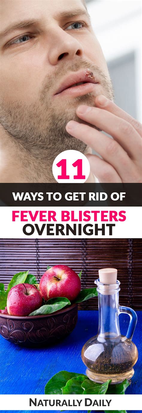 11 Ways to Get Rid of Fever Blisters Overnight | Fever blister, Fever ...