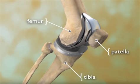 Total Knee Replacement - OrthoInfo - AAOS