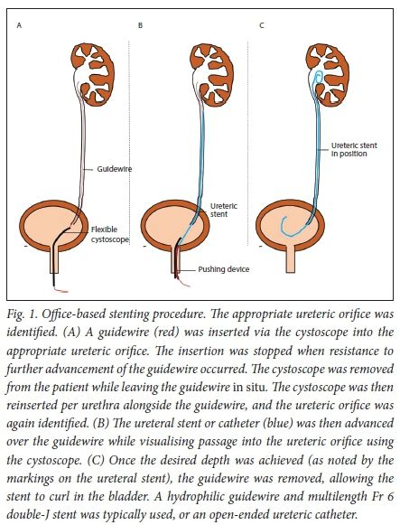 Urethral Stent Placement