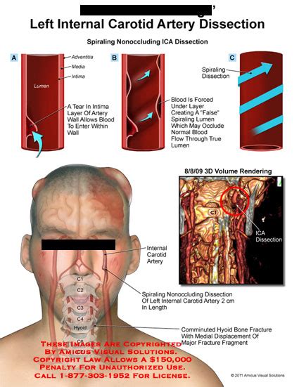 Carotid Artery, Internal, Dissection; Internal Carotid Artery Dissection