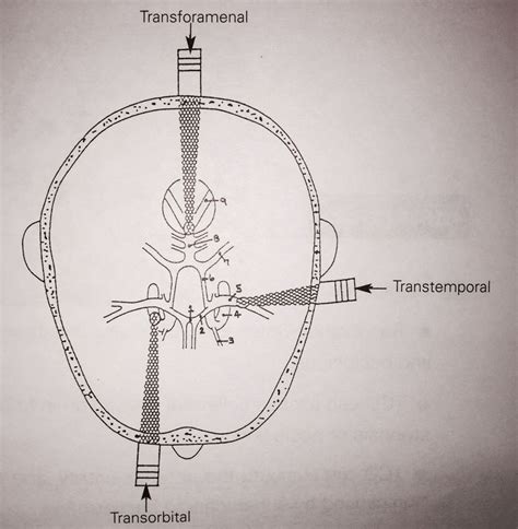 32 best TCD images on Pinterest | Medicine, Brain anatomy and Brain ...