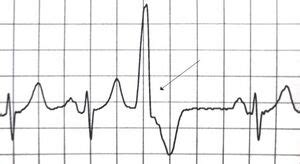 Ventricular Extrasystole - Physiopedia