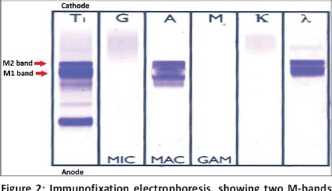 Figure 1 from Monoclonal gammopathy with double M-bands: An atypical ...