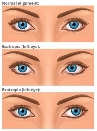 Double Vision (Diplopia): Causes, Definition & Treatments