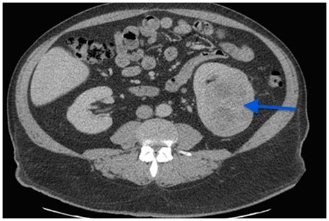 Recurrent metastatic clear cell renal carcinoma with sarcomatoid ...