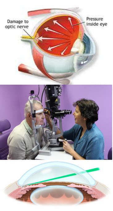 SLT Laser - Information on Eye Disorders by Dr Deans