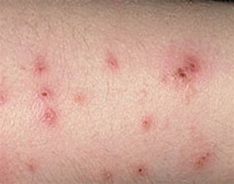 Bed Bug Bite - Pictures, Marks, Symptoms, Causes, Treatment