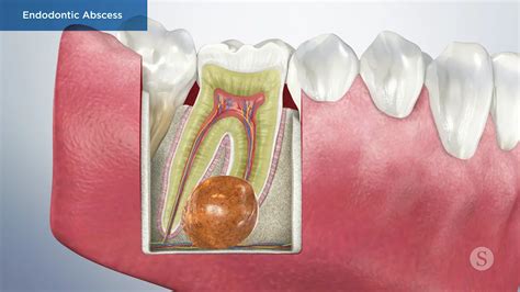 abscess tooth infection how to drain a gum abscess at home - Jina Stinnett