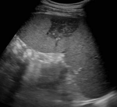 Abdomen and retroperitoneum | 1.4 Spleen : Case 1.4.3 Splenic infarcts | Ultrasound Cases