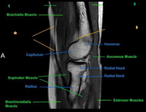 elbow sagittal MRI 3 Diagram | Quizlet