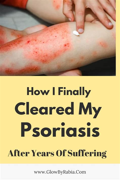 psoriasis Psoriasis Feet, Scalp Psoriasis Treatment, What Is Psoriasis, Psoriasis Cream, Plaque ...