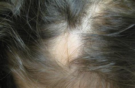 Alopecia Areata In Children