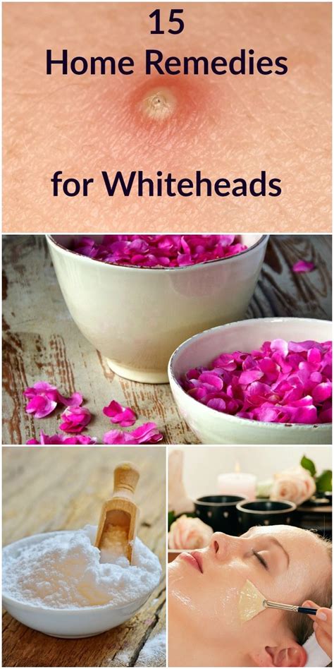 15 Home Remedies for Whiteheads | Skin care, Whitehead removal, Skin care tips