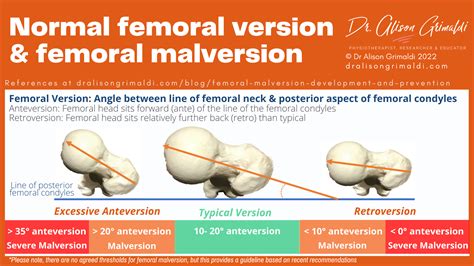 Femoral Anteversiyon