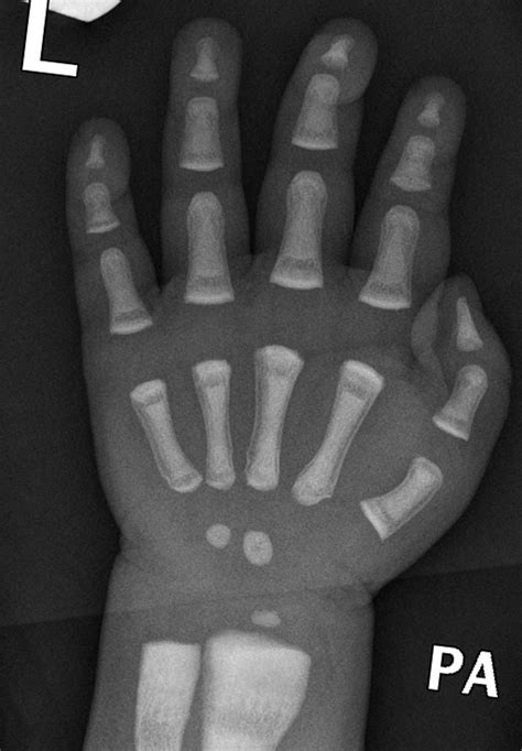 Osteopetrosis | Radiology Case | Radiopaedia.org | Radiology, Bone diseases, Radiography