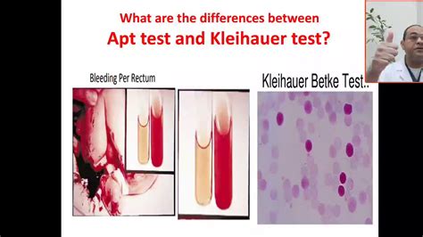 What are the differences between Apt and klehauer- Betke test ? Swallowing maternal blood, Rh ...