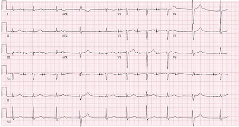 Ventricular Safety Pacing Triggered by Right Ventricular Lead Dislodgement | Circulation